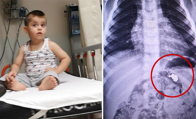 3 yaşındaki Yasin’in yuttuğu çengelli iğne çıkarıldı