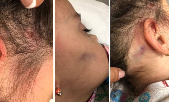 Anaokulunda akılalmaz olay! 2,5 yaşındaki kız çocuğuna yaşıtlarından dayak