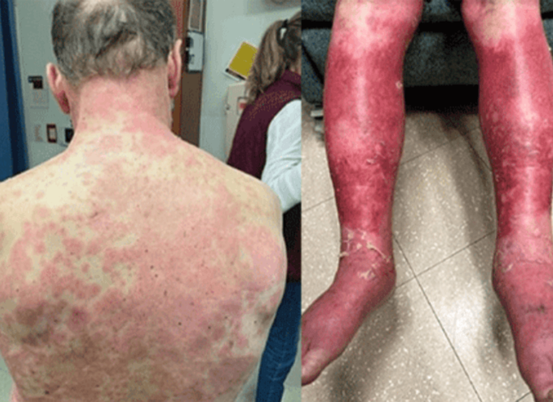 ABD’li koronavirüs aşısında yan etki! Bu hale geldi