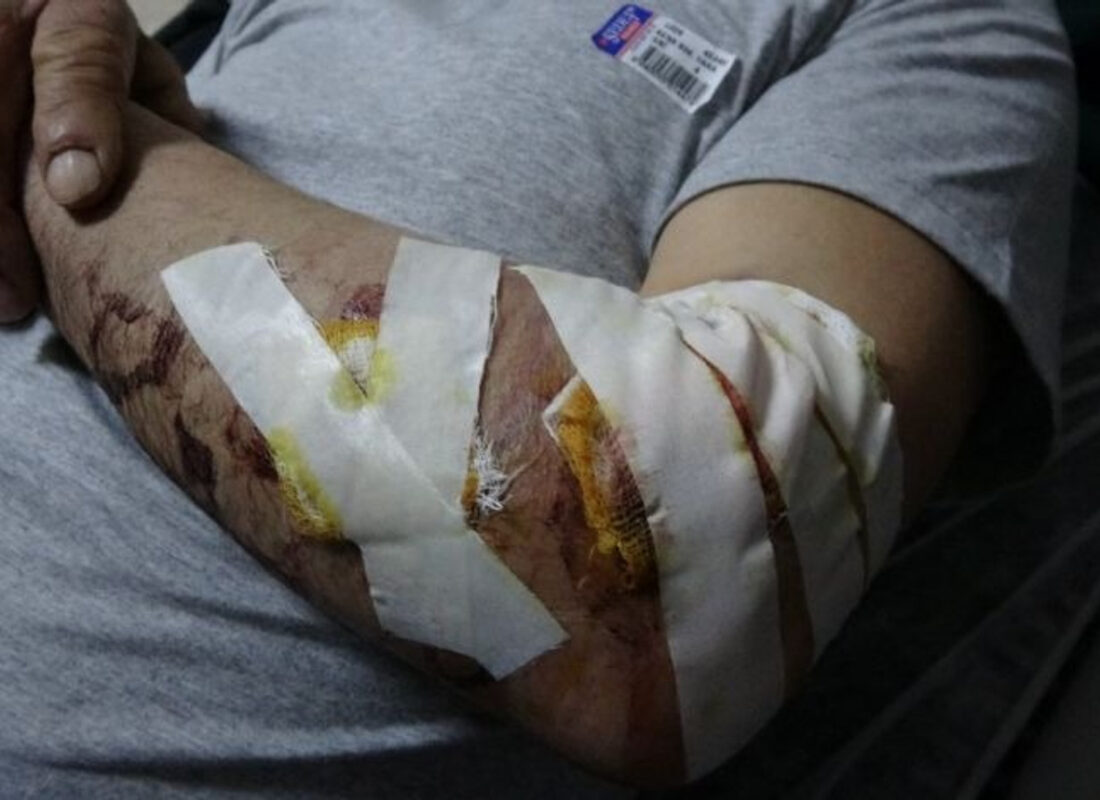 Başıboş köpek, yaşlı adamın kolunu bu hale getirdi! Helikopterle hastaneye kaldırıldı