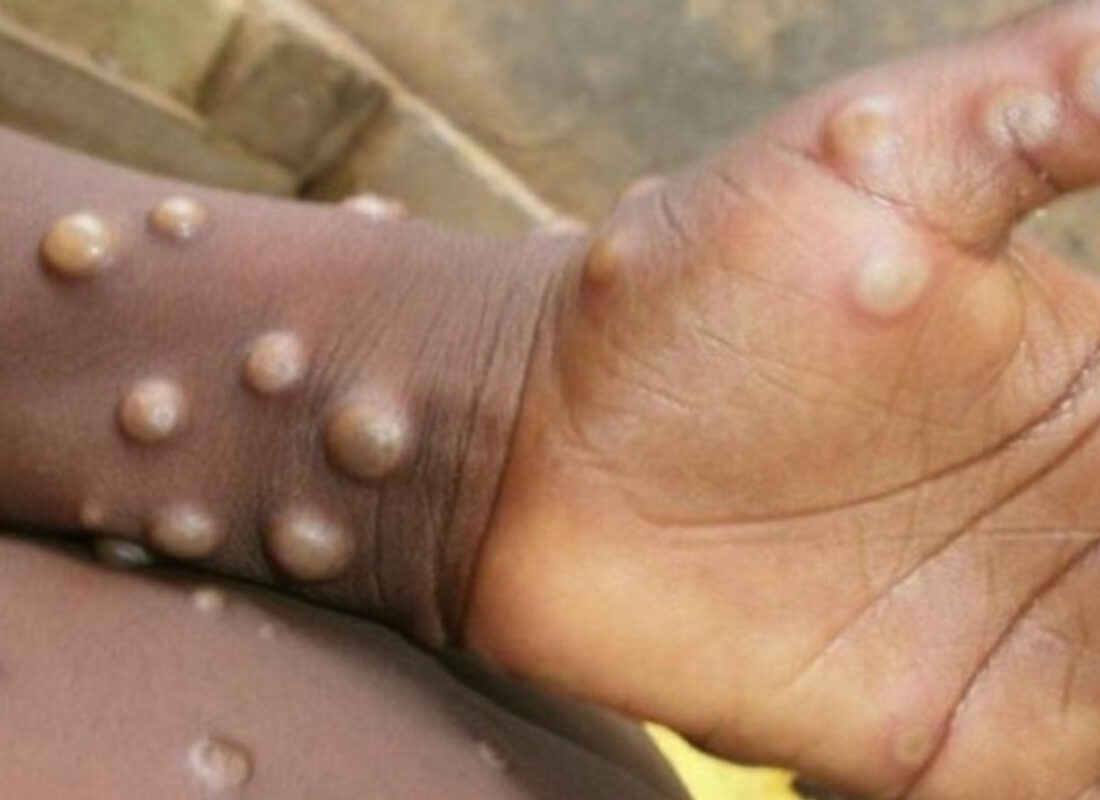 ABD’de görev yapan Türk profesörden maymun salgını için kritik öneri